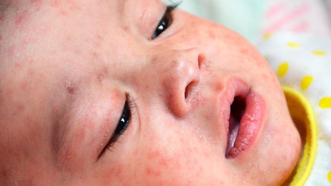 Бебетата и хората с компрометирана имунна система са най-уязвими към болестта. Снимка: BBC